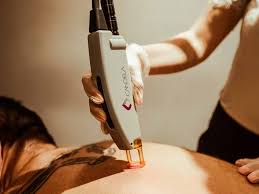 hair removal cream