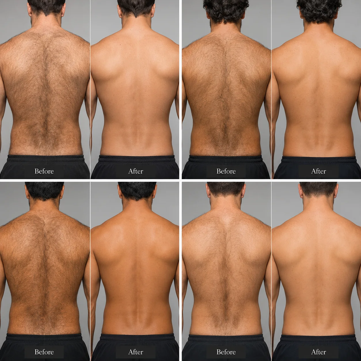 Before and after comparison showing professional men's back laser hair removal results with significant permanent hair reduction and smoother skin at Elite Laser Care serving Scottsdale, North Scottsdale, Phoenix, and North Phoenix, Arizona.