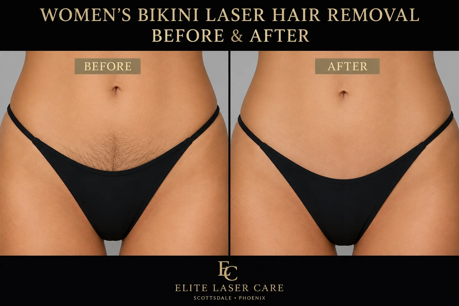 Women's Brazilian and bikini laser hair removal before and after comparison at Elite Laser Care in Scottsdale and Phoenix, Arizona